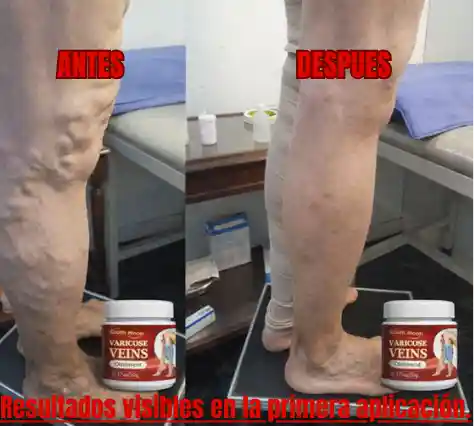 VaricoRelief®:Despídete de las várices en 30 dias.